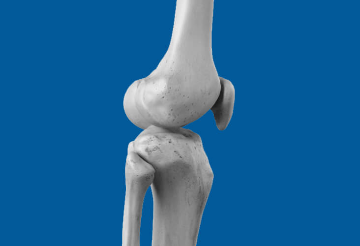 Arthrose du genou
