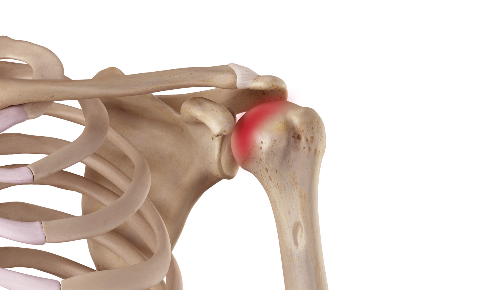 Arthrose de l'épaule