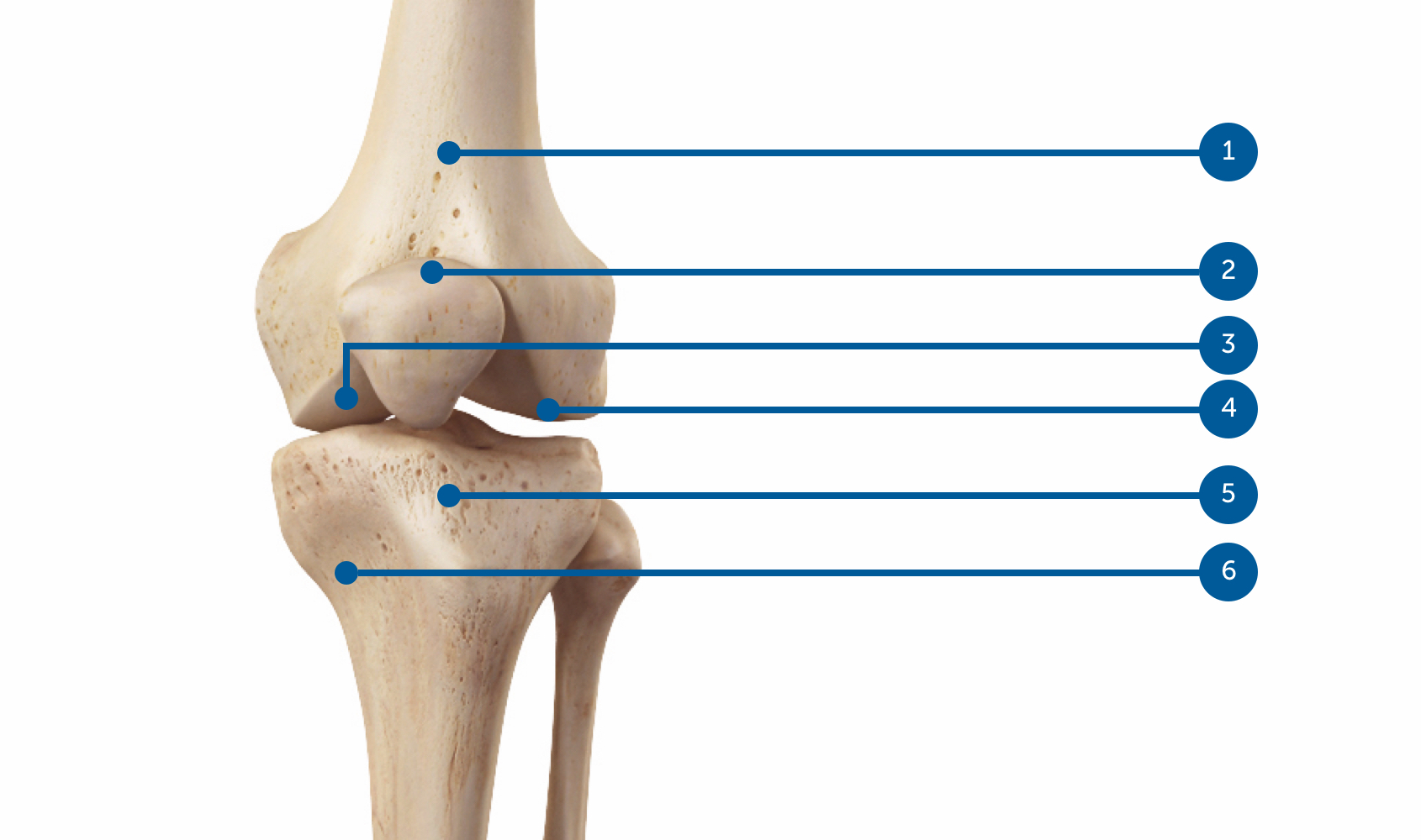 Arthrose du genou