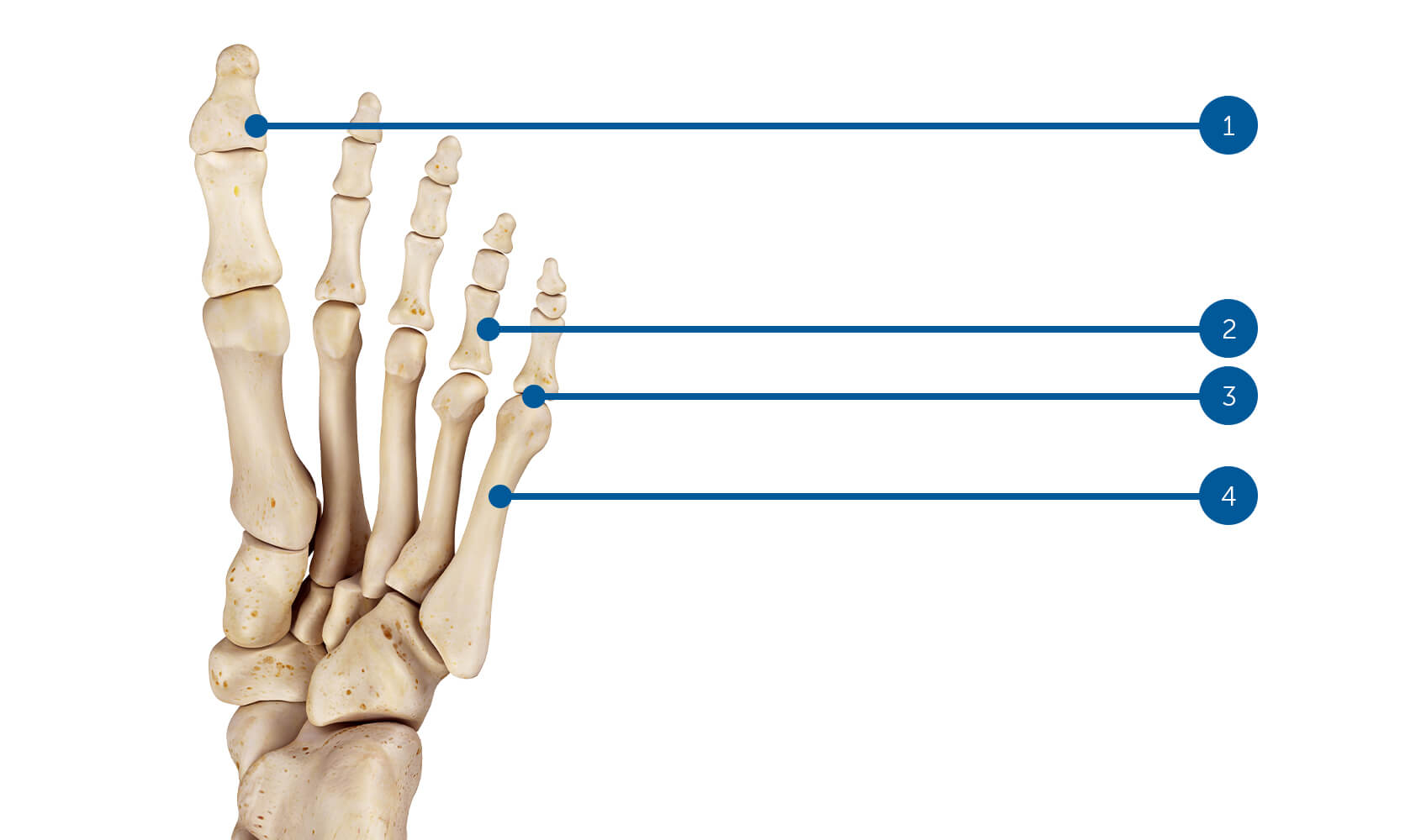 Hallux Valgus