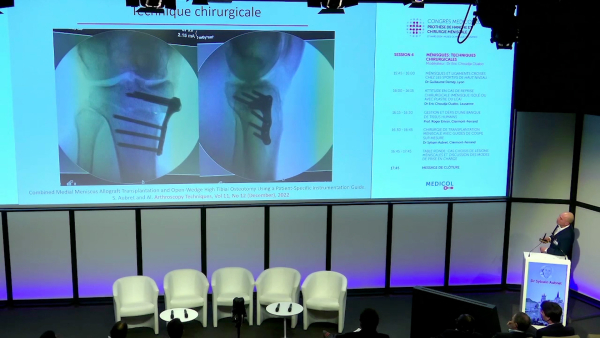 Chirurgie de transplantation m&eacute;niscale avec guides de coupe sur mesure