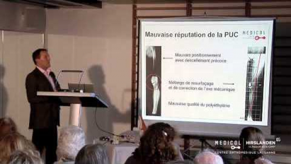 La proth&egrave;se du genou dans tous ses &eacute;tats