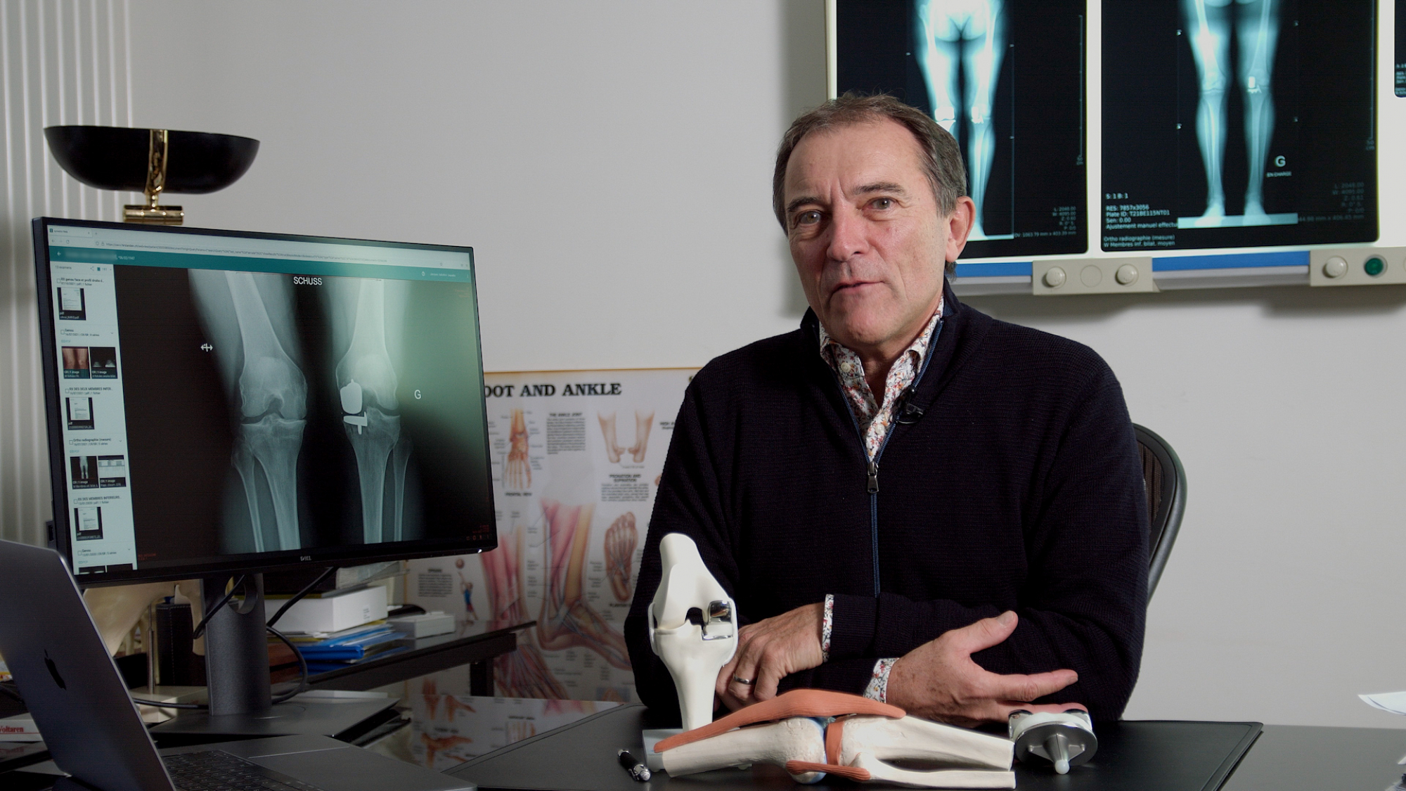 Chirurgie de r&eacute;vision apr&egrave;s proth&egrave;se du genou: privil&eacute;gier le r&eacute;sultat fonctionnel